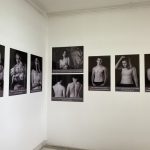 Izložbom fotografija Udruženje pacijenta ukazalo na značaj brige o sopstvenoj koži